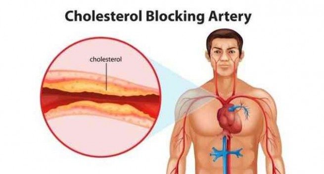 Can you lower high cholesterol naturally?