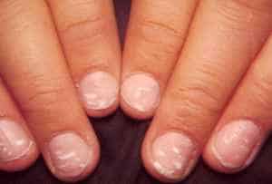 what are fingernail and toenail abnormalities?