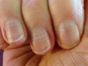 What do horizontal lines on the nails mean?