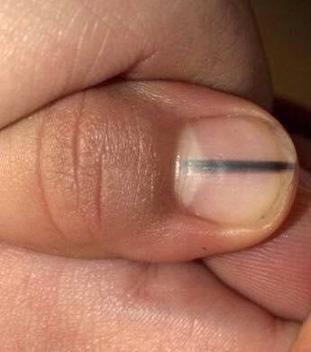 Gel Manicures Linked to Skin Cancer?