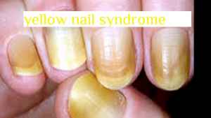 How do you get rid of yellow nails?